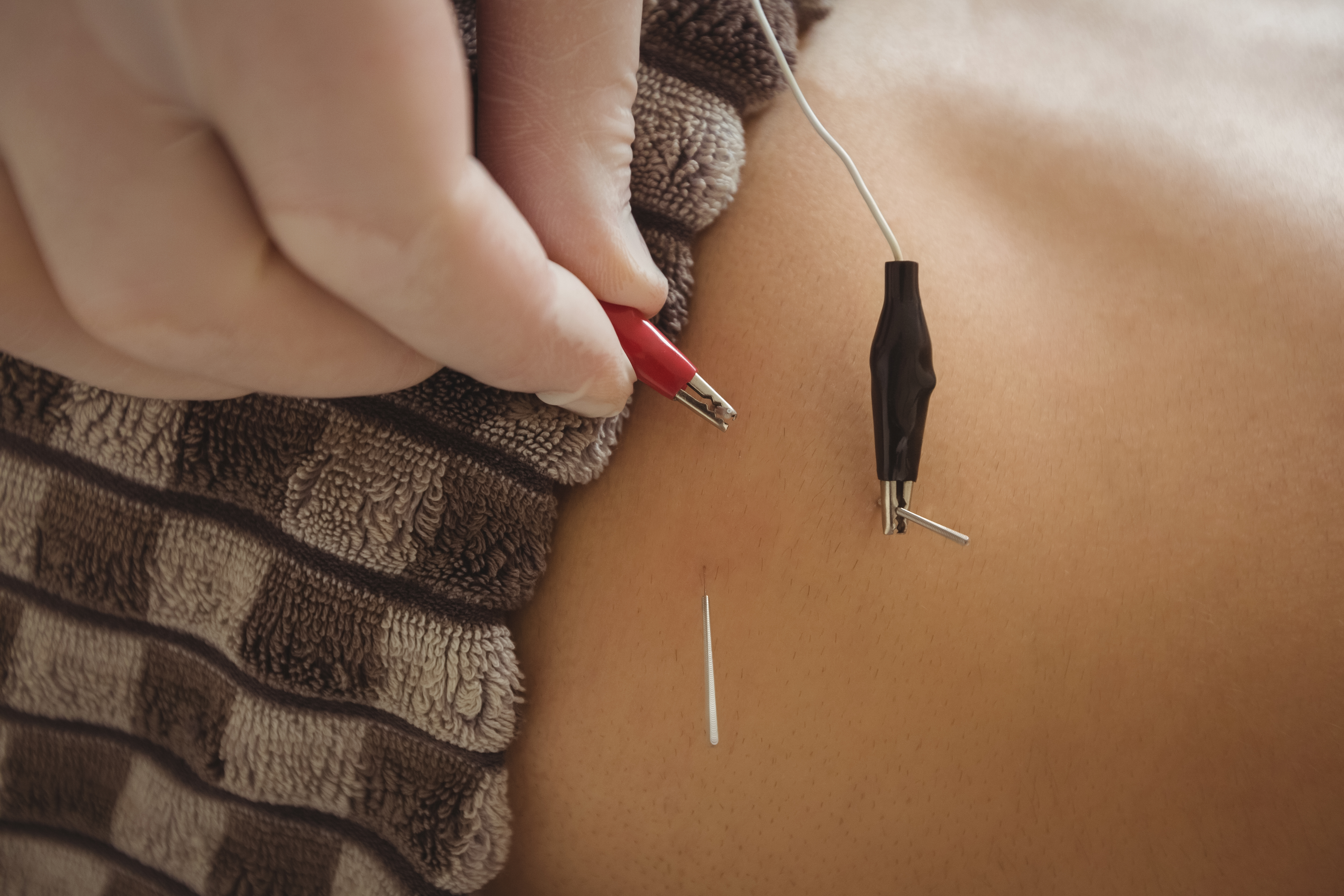 Acupuncture Therapy