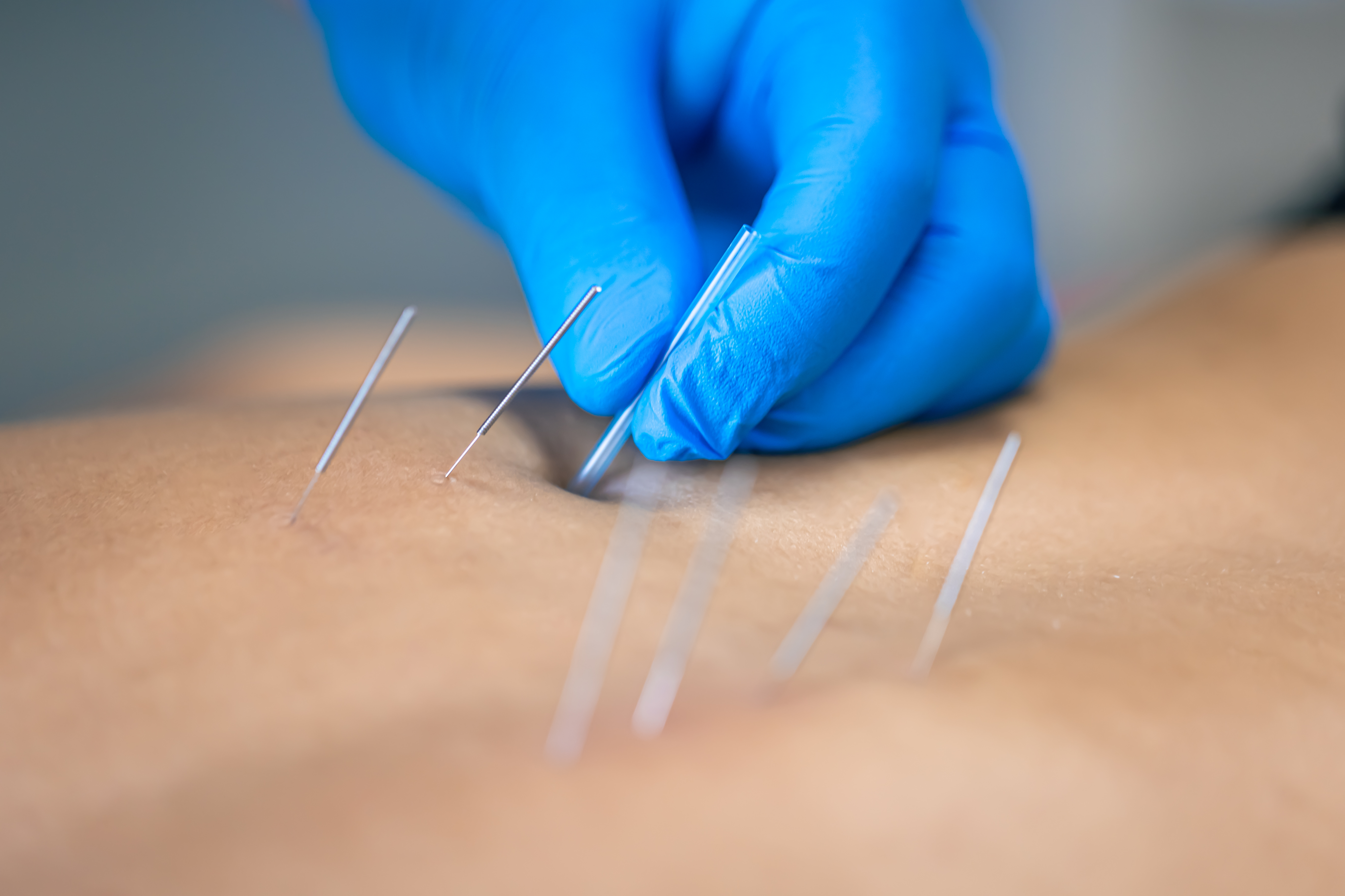 Dry Acupuncture